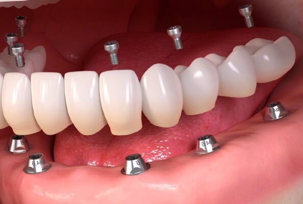 cómo ha evolucionado la dentadura postiza