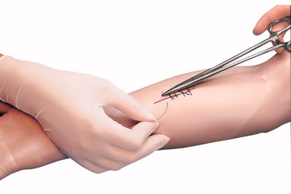 origen e historia de la sutura de heridas